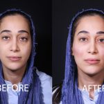 تزریق فیلر گونه