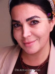 فیلر گونه
