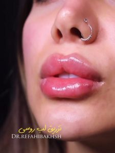 فیلر لب