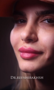 تزریق فیلر لب